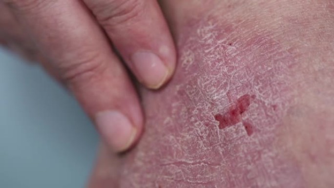 牛皮癣。一名男子按摩脚上受斑块影响的皮肤