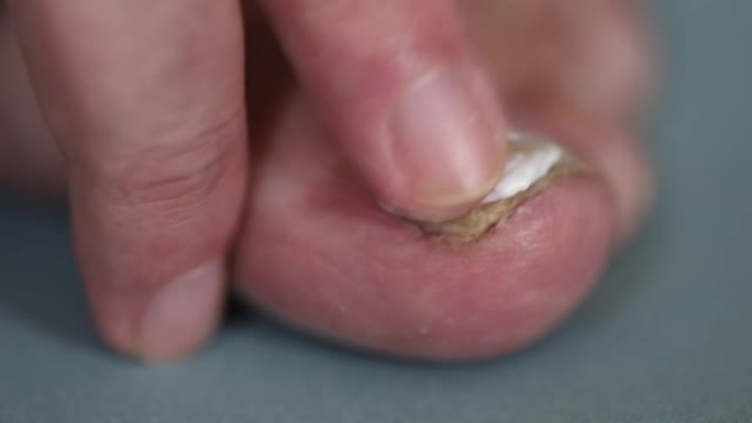 将软膏涂在大脚趾的趾甲真菌上