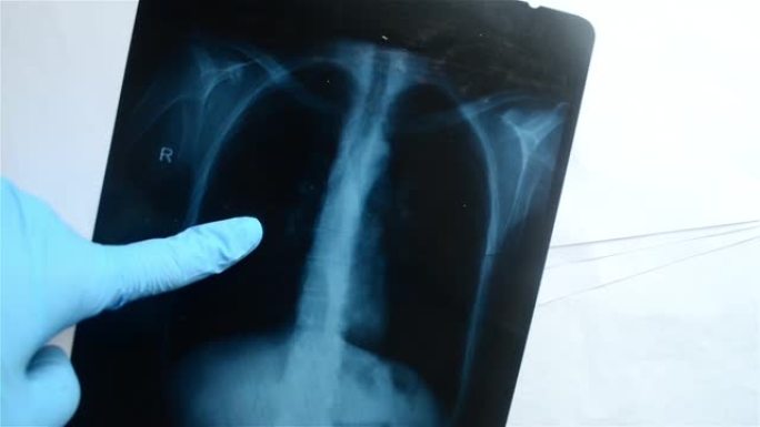 医生在肺部x射线照片上指着防护手套。新型冠状病毒肺炎冠状病毒肺炎的检测试验。医生检查