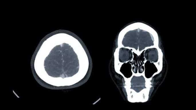 比较CTA脑或计算机断层扫描血管造影的脑轴和冠状位MIP视图。