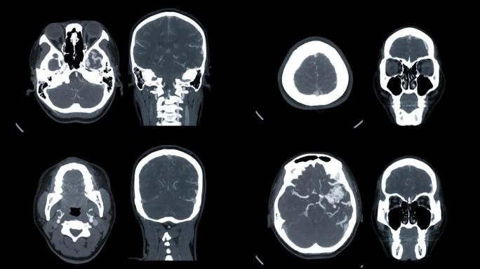 比较CTA脑或计算机断层扫描血管造影的脑轴和冠状位MIP视图。
