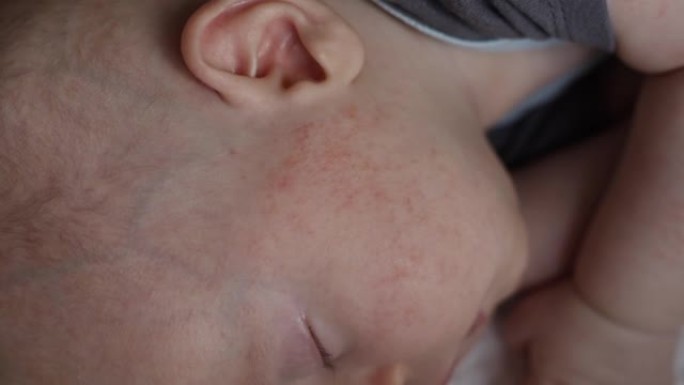 过敏特应性皮炎婴儿面部脸颊和手臂湿疹特写视图