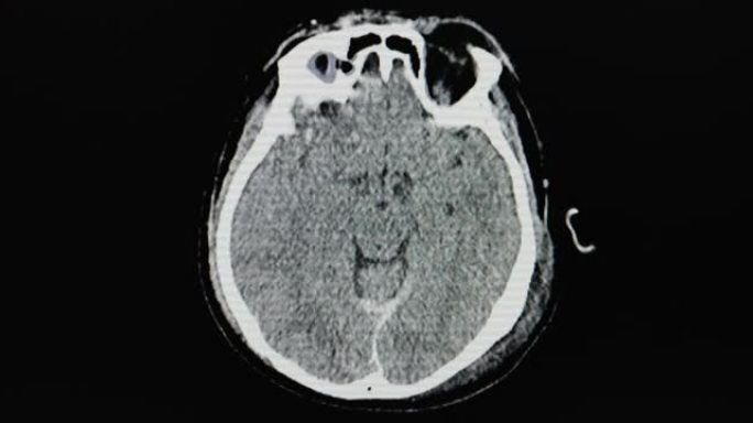 脑部CT显示出血性挫伤。