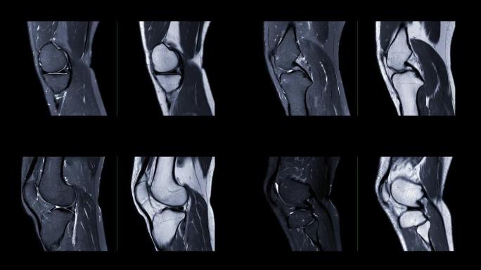 MRI膝关节或膝关节磁共振成像比较矢状面T2W和