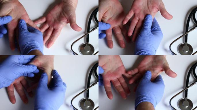女人看着抓痒的手，患有严重的湿疹，特应性皮炎。皮肤皲裂的红色