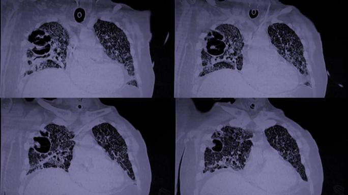 SARS-Co-V2新型冠状病毒肺炎和烟曲霉腔的患者的CAT扫描视频。