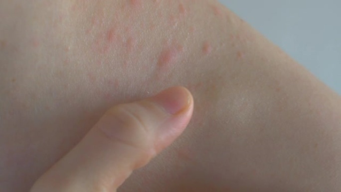 一根手指慢慢越过皮肤表面。发炎的皮肤区域被触摸。皮肤上有不同大小的炎症。面部和颈部出现皮疹。过敏性皮