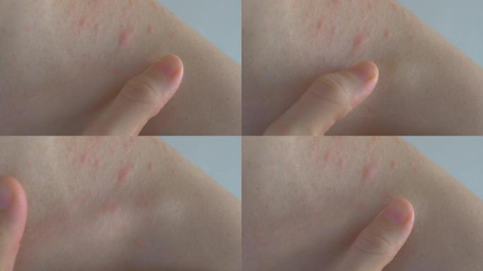 一根手指慢慢越过皮肤表面。发炎的皮肤区域被触摸。皮肤上有不同大小的炎症。面部和颈部出现皮疹。过敏性皮