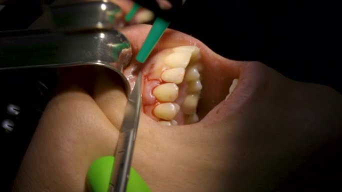 牙科介入手术