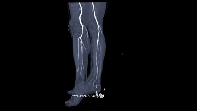 腿部CTA或腿部CT血管造影在屏幕上转动以检测外周动脉疾病。