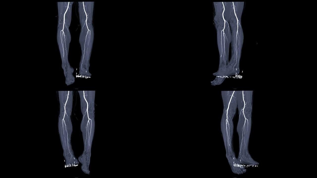 腿部CTA或腿部CT血管造影在屏幕上转动以检测外周动脉疾病。