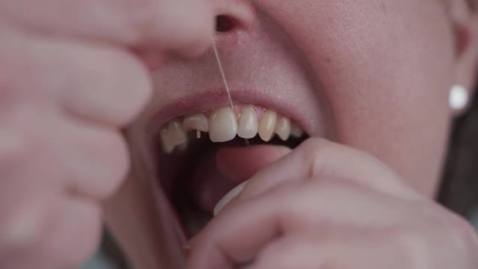 牙线每天清洁和卫生口腔的重要属性。牙齿不好的女人用牙线尝试正确的情况。牙齿折断的女性。牙齿损坏导致卫
