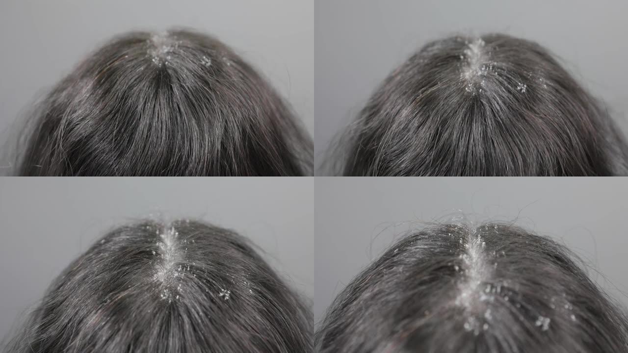 头皮屑特写的脏头发。顶视图。相机从头部后部沿头发分开的移动。头皮问题和疾病的概念