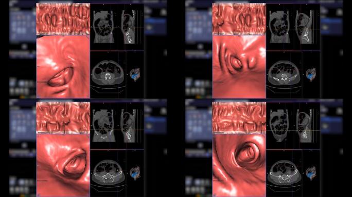 CT结肠造影比较显示结肠内的轴向，冠状，矢状和3D渲染电影，用于筛查结直肠癌。检查结肠癌筛查。