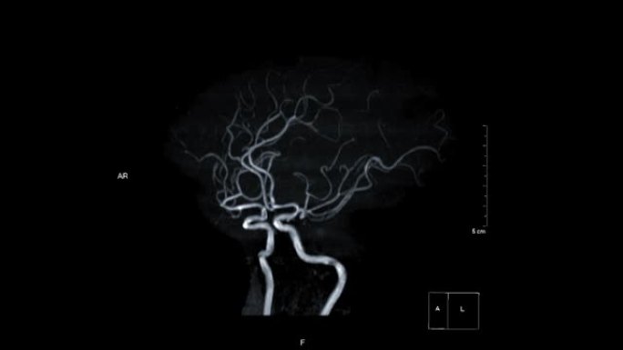 大脑前动脉或ICA i的MRA脑或磁共振血管造影。