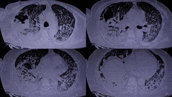 SARS-Co-V2新型冠状病毒肺炎和烟曲霉腔的患者的CAT扫描视频。