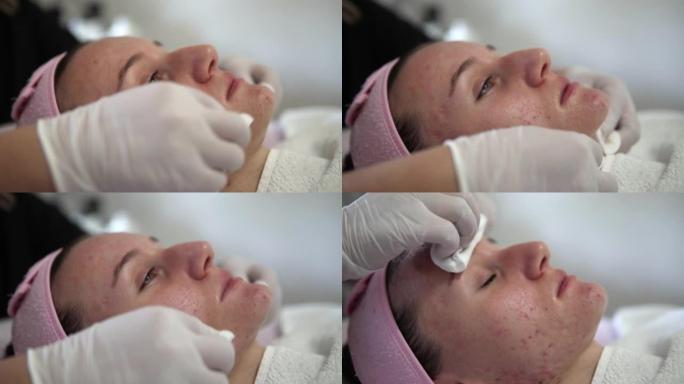 美容师在美容水疗沙龙中使用带棉垫的冷氢化凝胶在年轻女性脸上治疗痤疮