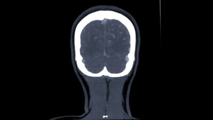 CTA脑或计算机断层扫描血管造影的脑冠状MIP图像显示脑AVM。