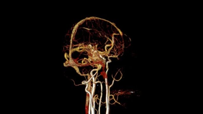 CTA脑或计算机断层扫描血管造影的脑3D渲染图像。