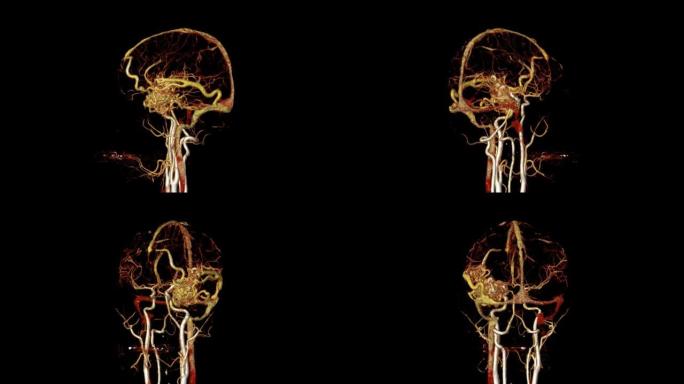 CTA脑或计算机断层扫描血管造影的脑3D渲染图像。