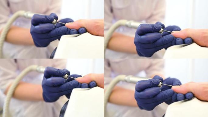 特写-医生或修脚大师用带有旋转切割器的专用工具治疗患者的指甲