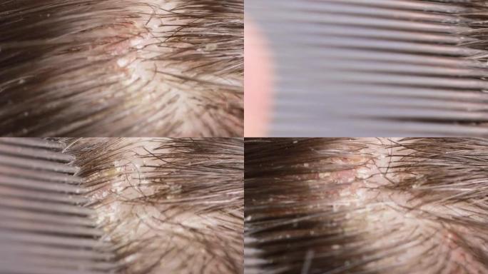 深色头发上的宏视频皮屑。头皮干，洗发错，头上有真菌的问题
