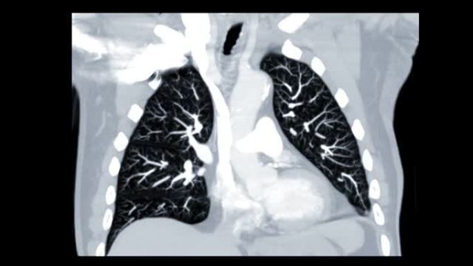 CT胸部肺窗冠状视图用于诊断电晕病毒或covid19和肺部疾病。