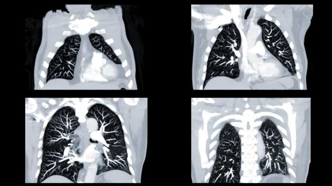 CT胸部肺窗冠状视图用于诊断电晕病毒或covid19和肺部疾病。