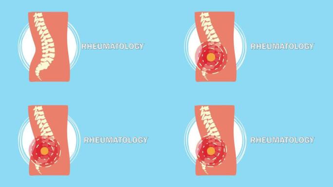 脊柱人体骨痛动画