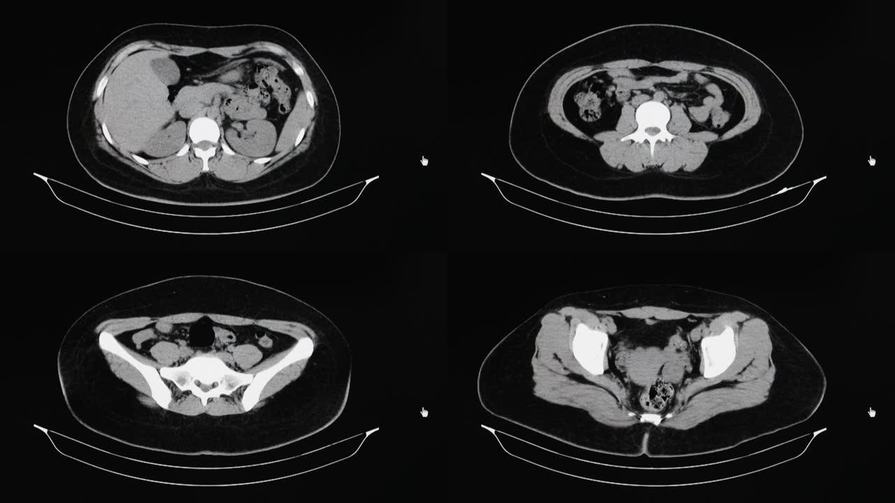 女性卵巢囊肿患者腹部的CT罐。