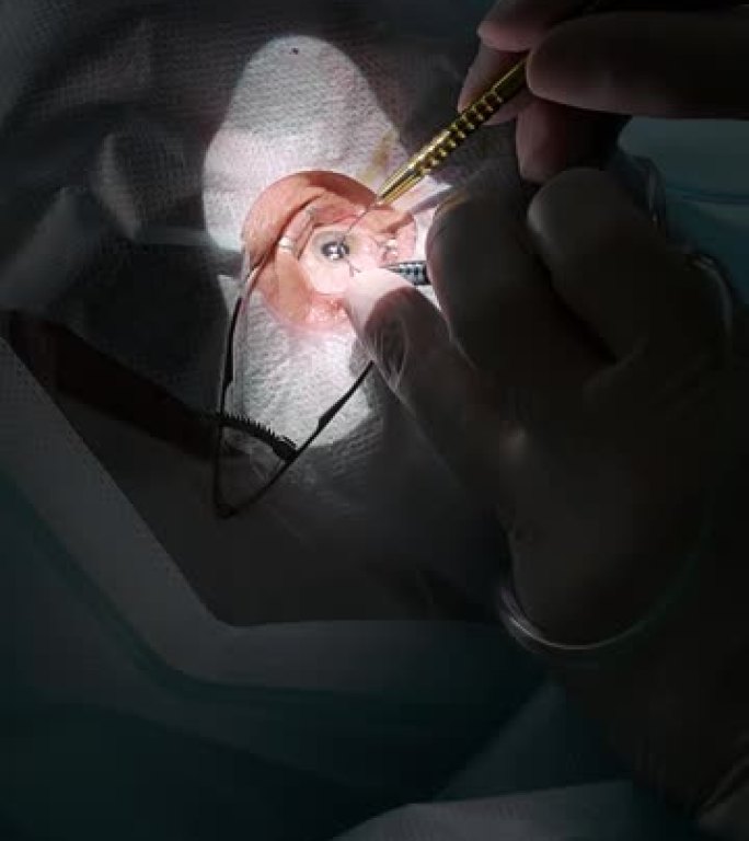 眼科手术的特写。外科团队在医疗诊所进行眼科手术。