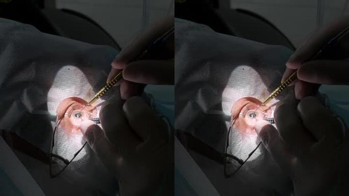 眼科手术的特写。外科团队在医疗诊所进行眼科手术。