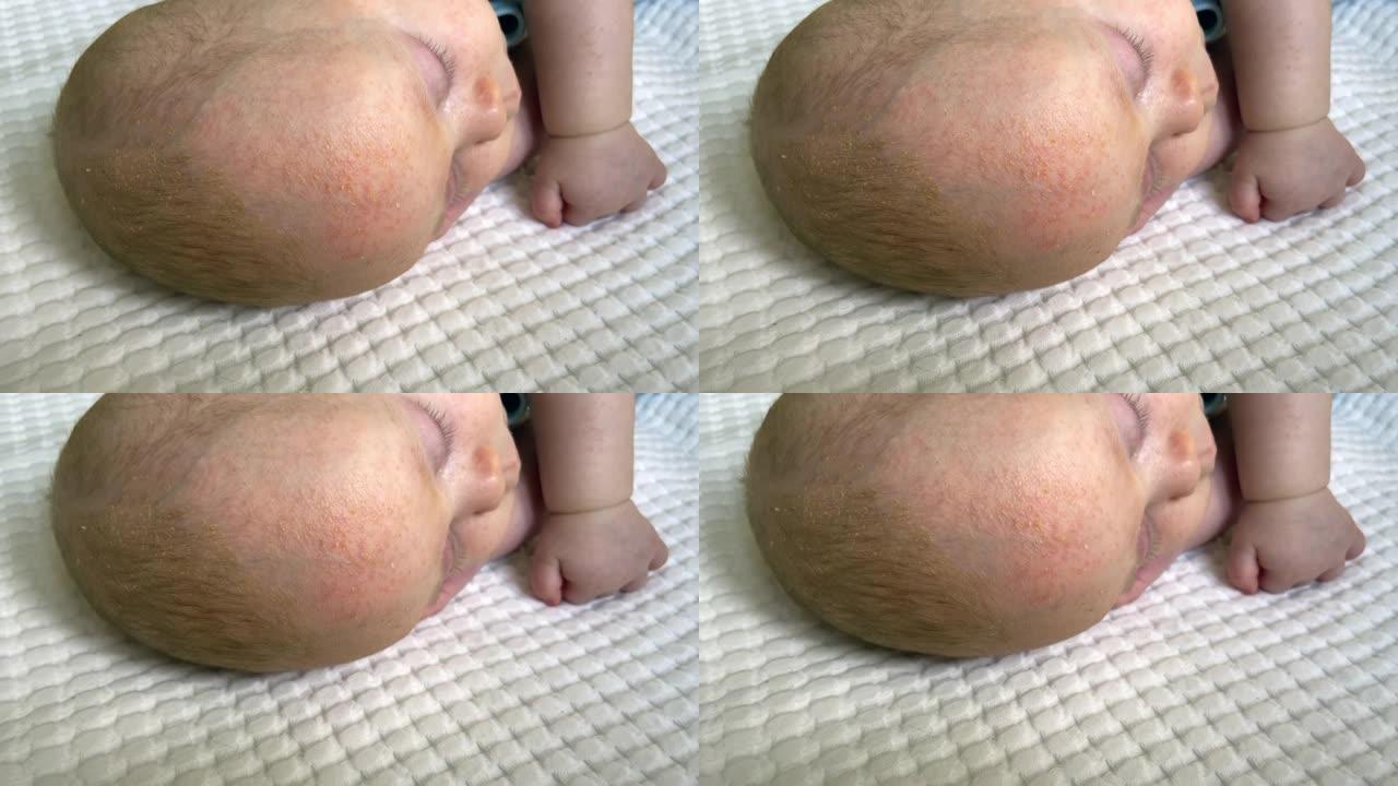 新生婴儿皮脂溢皮肤问题过敏或头部和额头皮疹