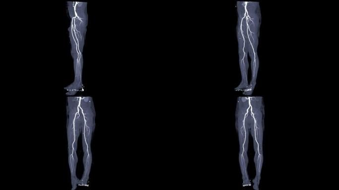 CTA股动脉跑掉血管造影视图在屏幕上转过来检测外周动脉疾病。