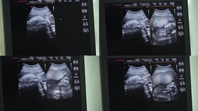 超声波手术中母亲腹部的婴儿