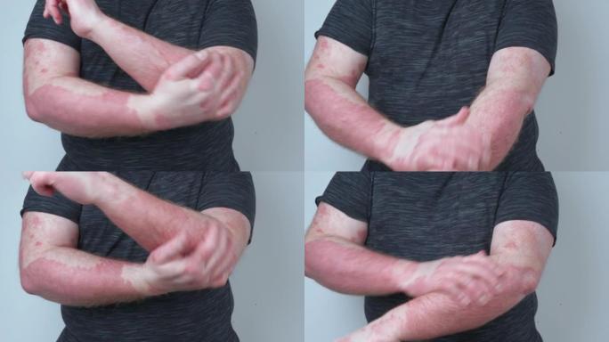 一个家伙用药膏涂抹他的手，他的手上沾满了牛皮癣，这很痒，湿疹的概念和其他疾病的干燥皮肤