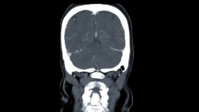注射造影剂检测脑动脉瘤后CTA脑冠状MIP视图