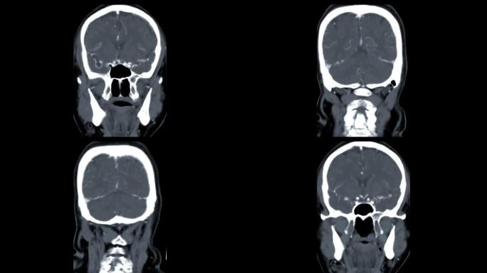 注射造影剂检测脑动脉瘤后CTA脑冠状MIP视图