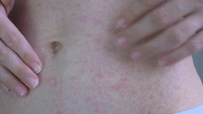 手显示腹部皮肤的受影响区域。在红疹的区域。离肚脐一厘米处是皮疹和结痂。病毒性疾病。特写