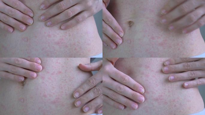 手显示腹部皮肤的受影响区域。在红疹的区域。离肚脐一厘米处是皮疹和结痂。病毒性疾病。特写