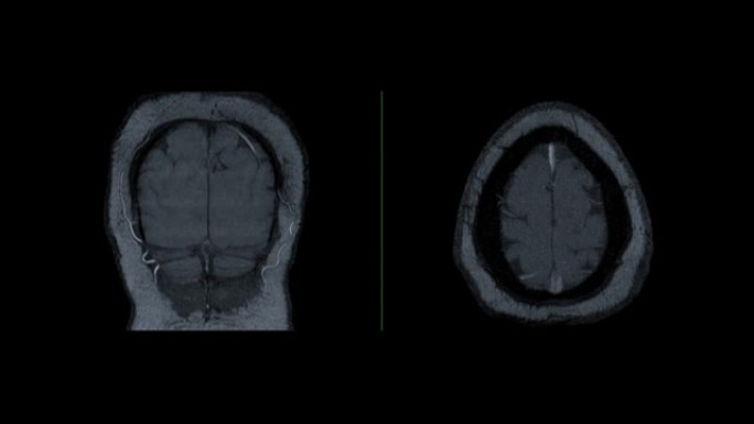 比较MRA脑或磁共振血管造影的脑轴和冠状动脉MIP视图显示脑动脉。