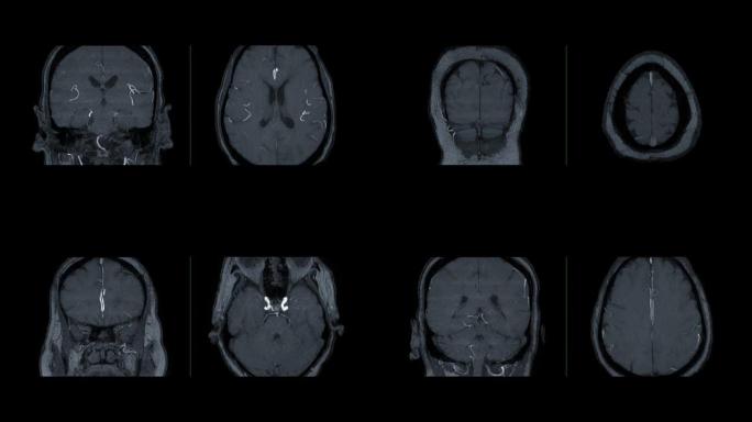 比较MRA脑或磁共振血管造影的脑轴和冠状动脉MIP视图显示脑动脉。