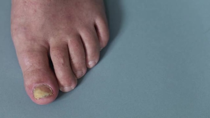 脚有受真菌影响的拇指指甲