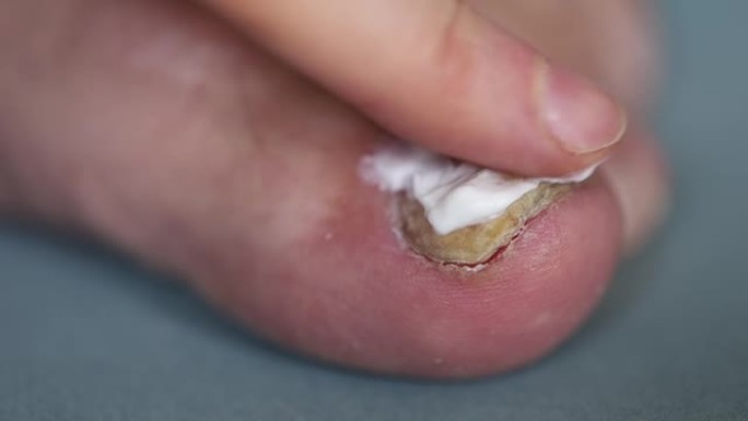 手的手指将药膏涂在大脚趾上的指甲真菌上