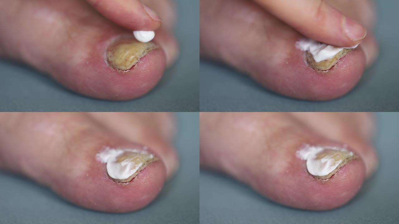 手的手指将药膏涂在大脚趾上的指甲真菌上