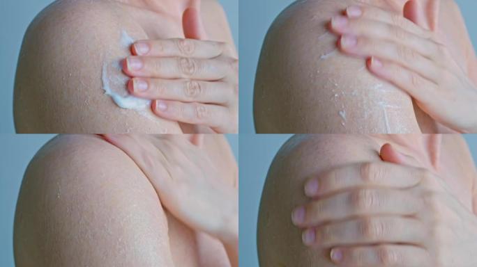 一名妇女将白色保湿霜涂在皮肤的问题区域，皮肤干燥并脱皮。皮肤问题。身体护理。特写
