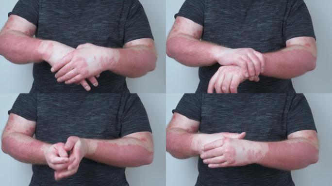 一个家伙用药膏涂抹他的手，他的手上沾满了牛皮癣，这很痒，湿疹的概念和其他疾病的干燥皮肤