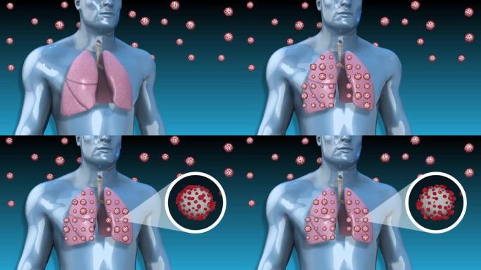 呼吸系统和肺部冠状病毒或新型冠状病毒肺炎的3D动画。
