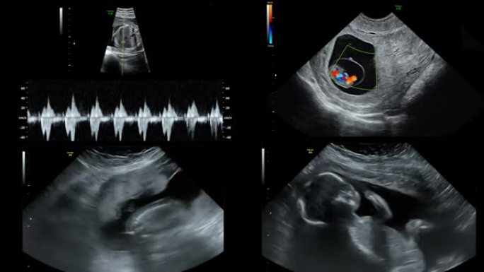 孕妇腹部超声扫描仪视频。