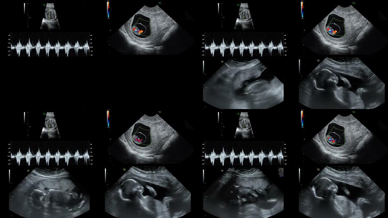 孕妇腹部超声扫描仪视频。